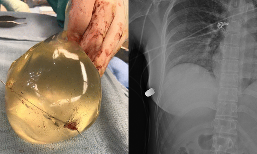 Woman’s Breast Implant Deflects .40-Caliber Bullet, Saving Her Life