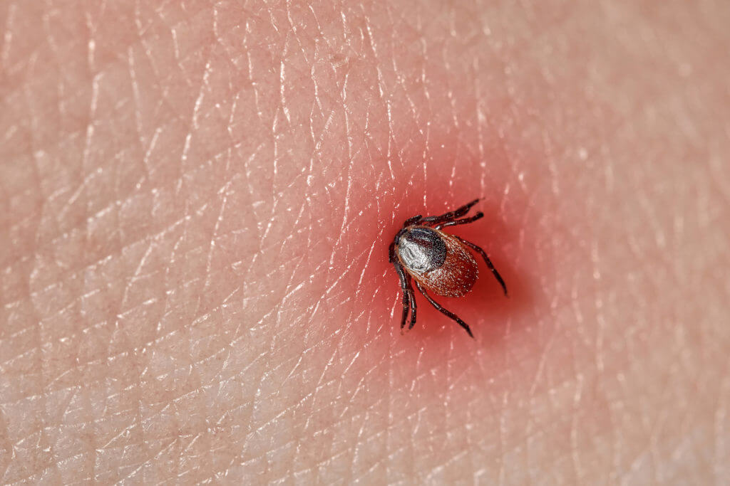 Tick fully planted in skin